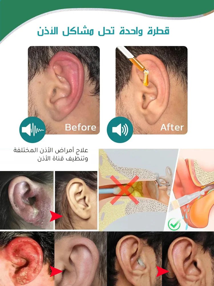 BE3176 | 【وداعًا لانزعاج الأذن】قطرات أذن لتخفيف الطنين -v4 BE3176 | 【وداعًا لانزعاج الأذن】قطرات أذن لتخفيف الطنين -v4